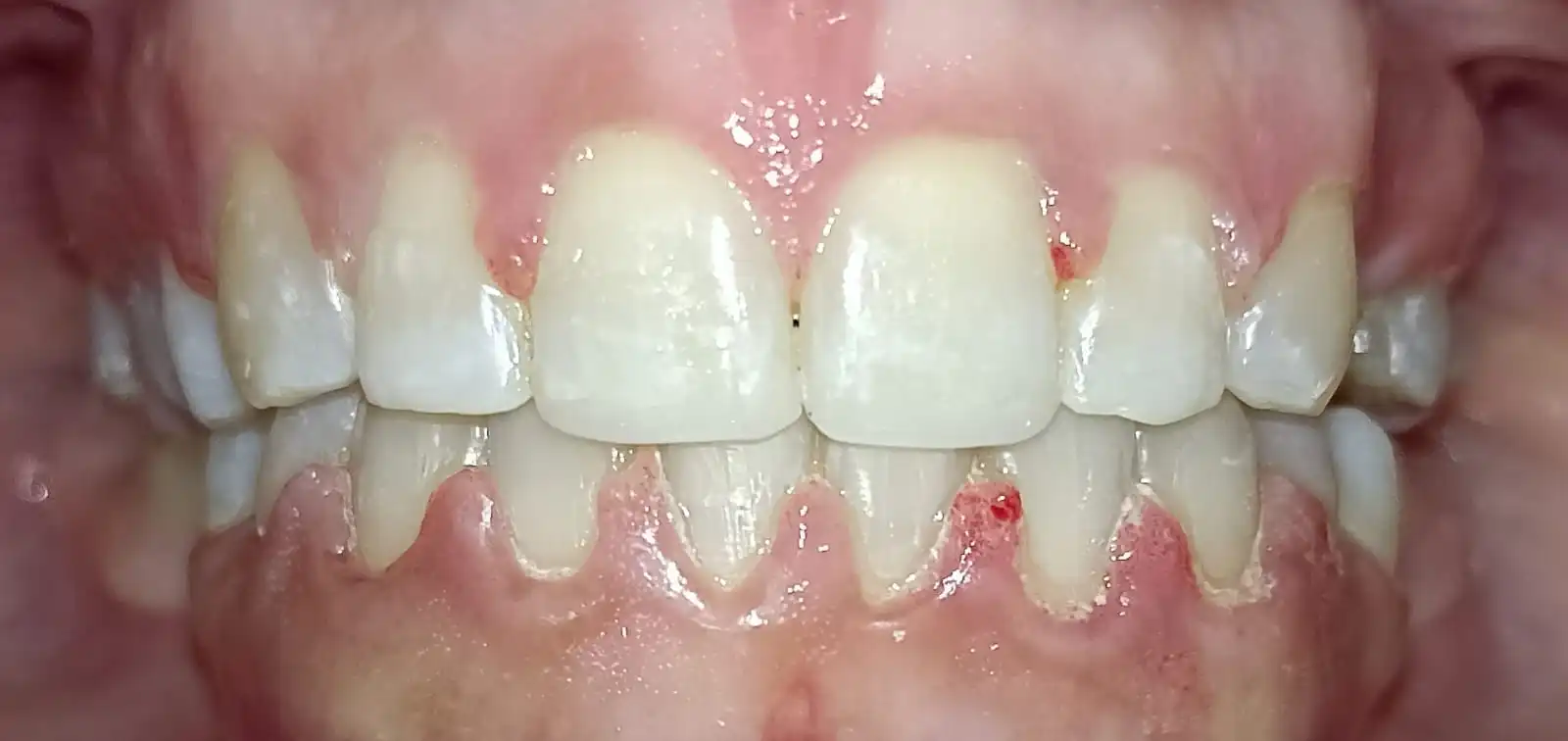 Después del tratamiento de Vicky